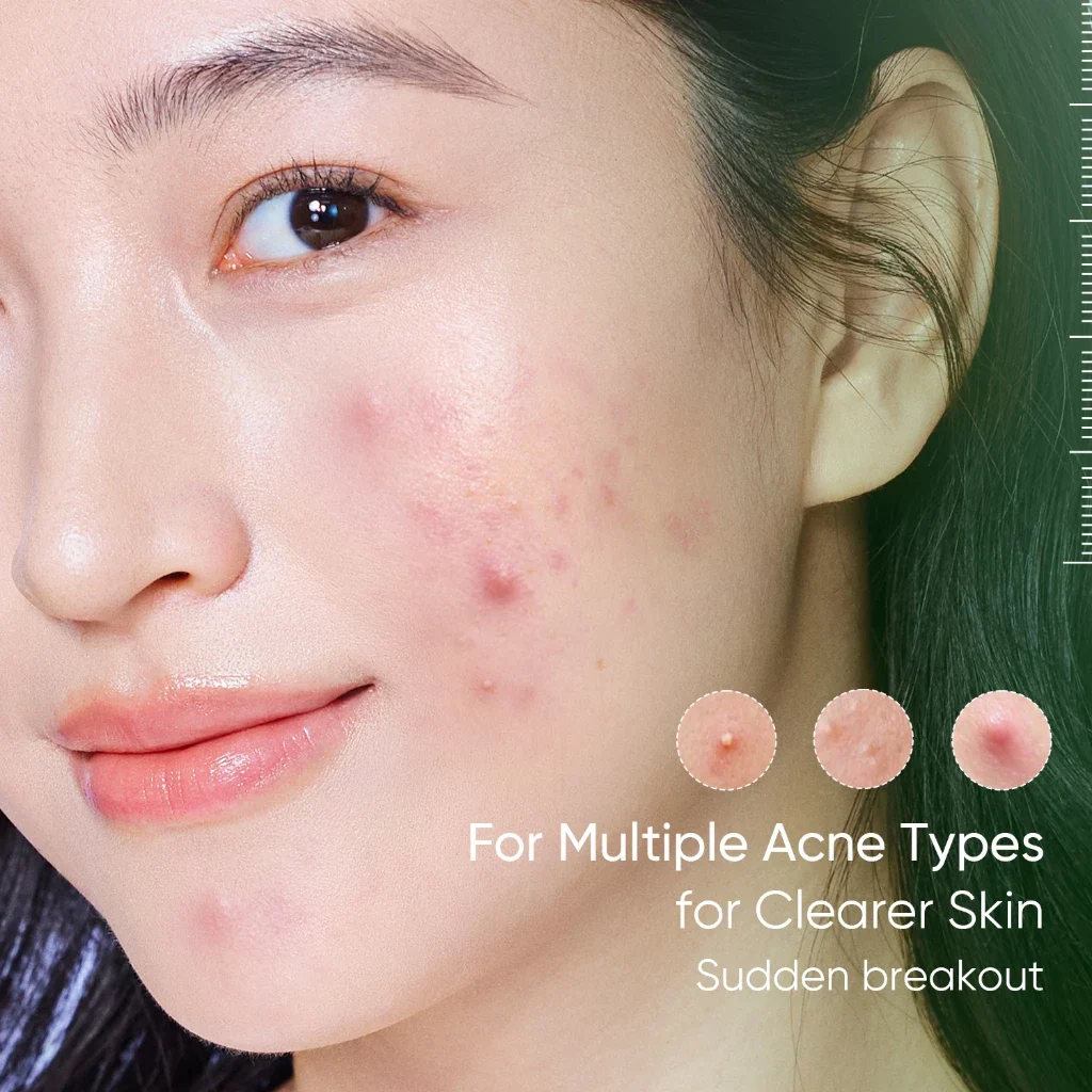 SKINTIFIC Acne Drying Lotion Kit - Image 2